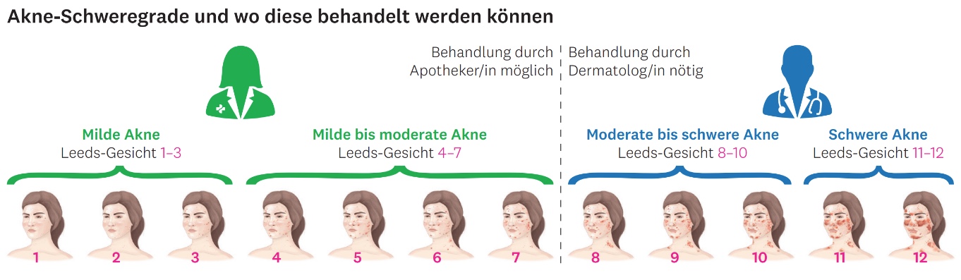 Akne_Schweregrade
